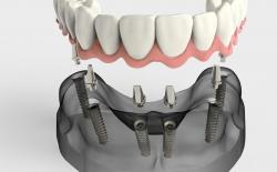 Full lower jaw dental implants