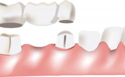 Dental Bridge