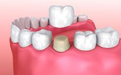 Dental crown fitting