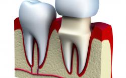 Loose Dental Crown