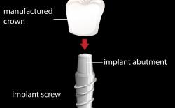 Zirconia dental implant with abutment and crown