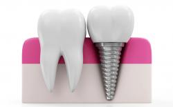 Dental implant and tooth