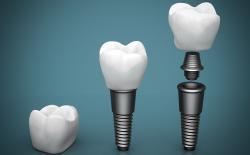 Same day dental implant