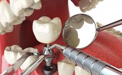 Dental implant procedure with titanium implant