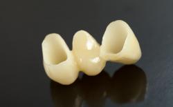 Emax pressed ceramic bridge