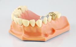 Gold crown model in a dental lab