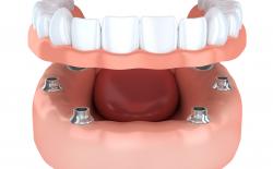 Implant supported denture