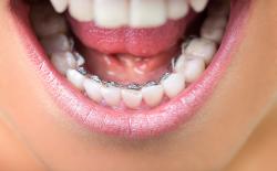 Lingual braces