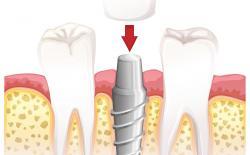 Single dental implant