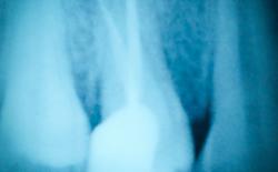 Xray of root canal therapy