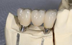 Zirconia bridge on dental implants