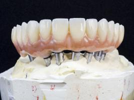 Implant supported zirconia restoration