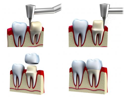 Dental crown procedure