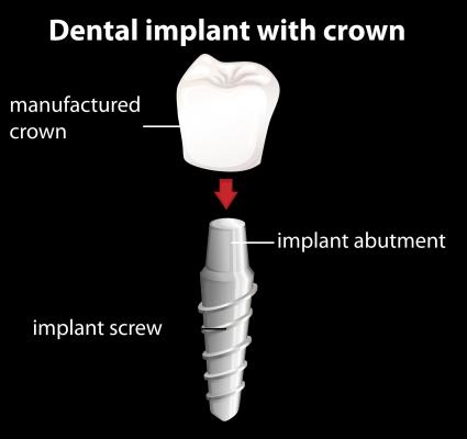 Dental Implant and Crown