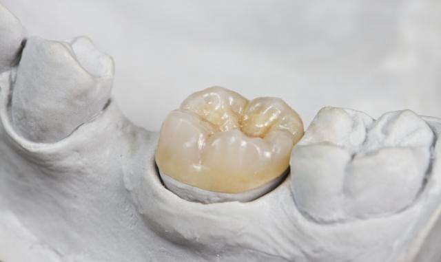 Onlay on molar tooth