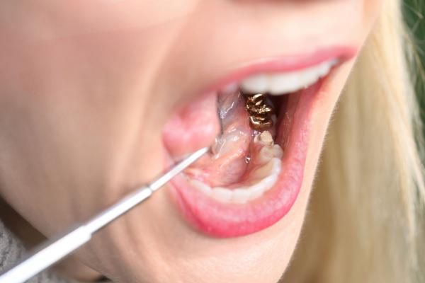 Gold Crown on Tooth