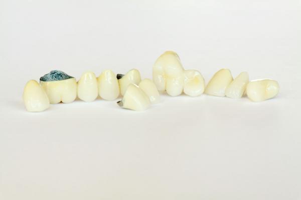 Porcelain fused to metal crowns